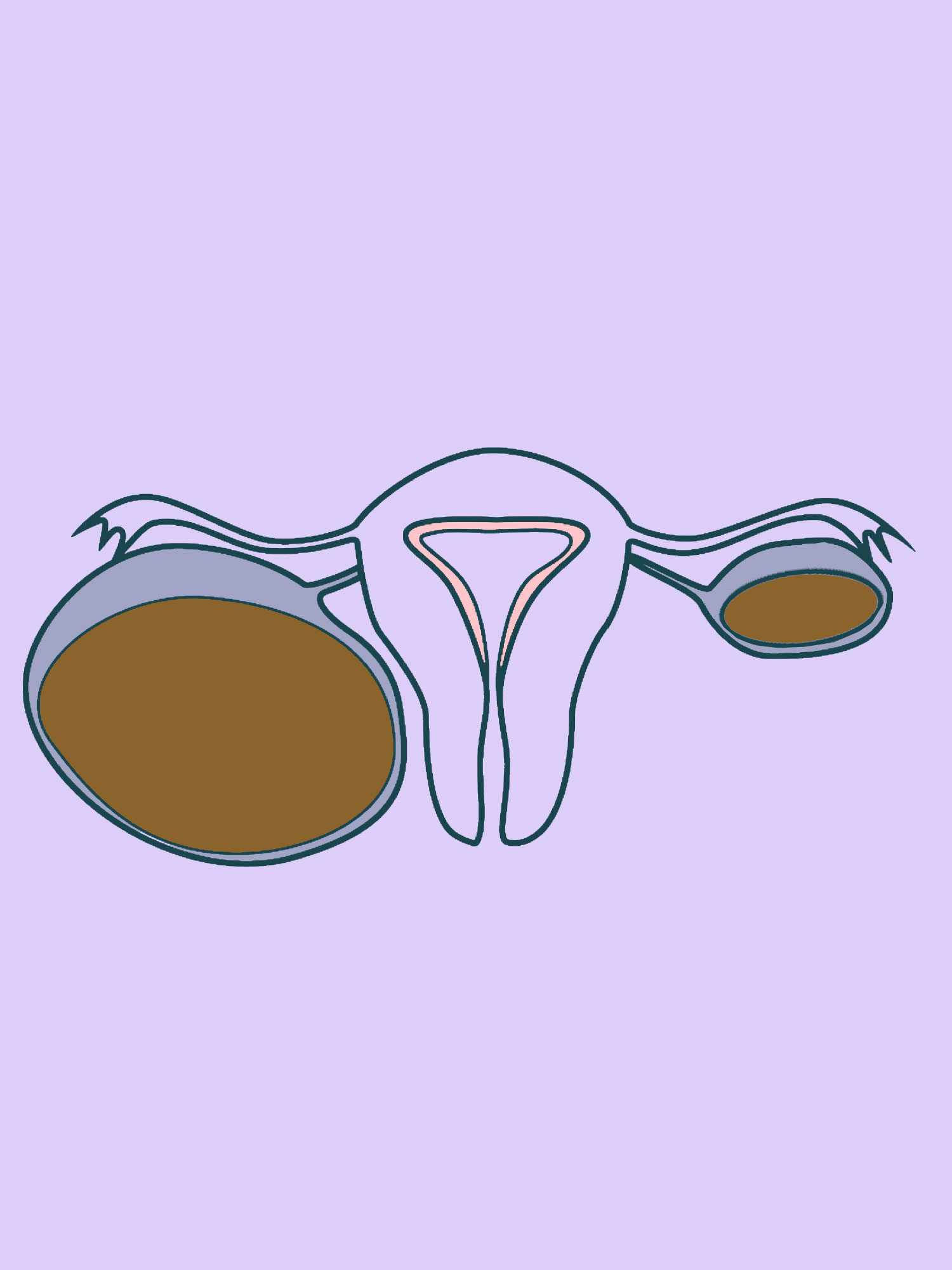 Endometriozes cista