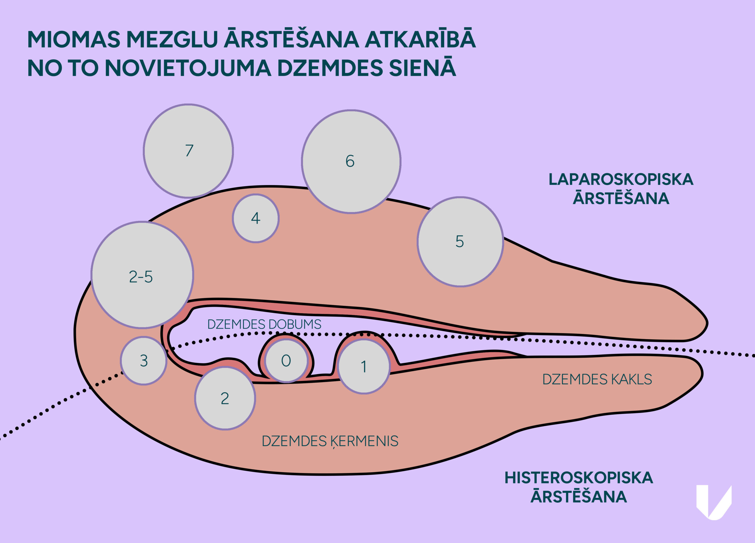 Miomas mezglu ārstēšana artkarībā no to novietojuma dzemdes sienā