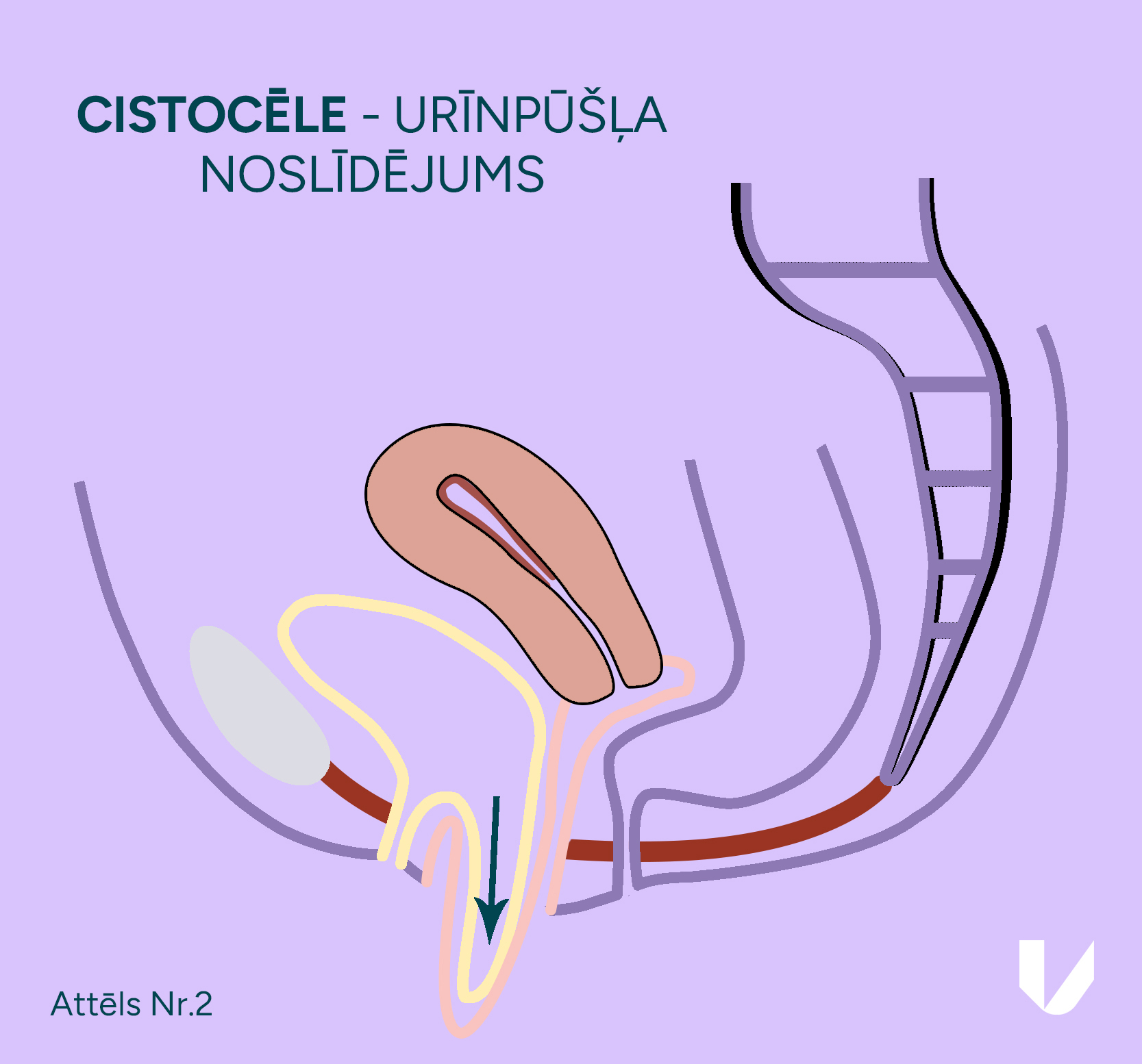 Cistocēle – maksts priekšējās sienas noslīdējums