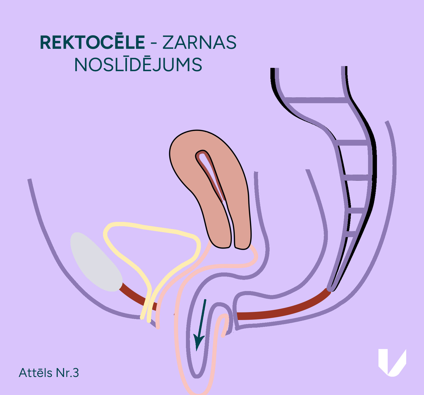 Rektocēle – maksts mugurējās sienas noslīdējums