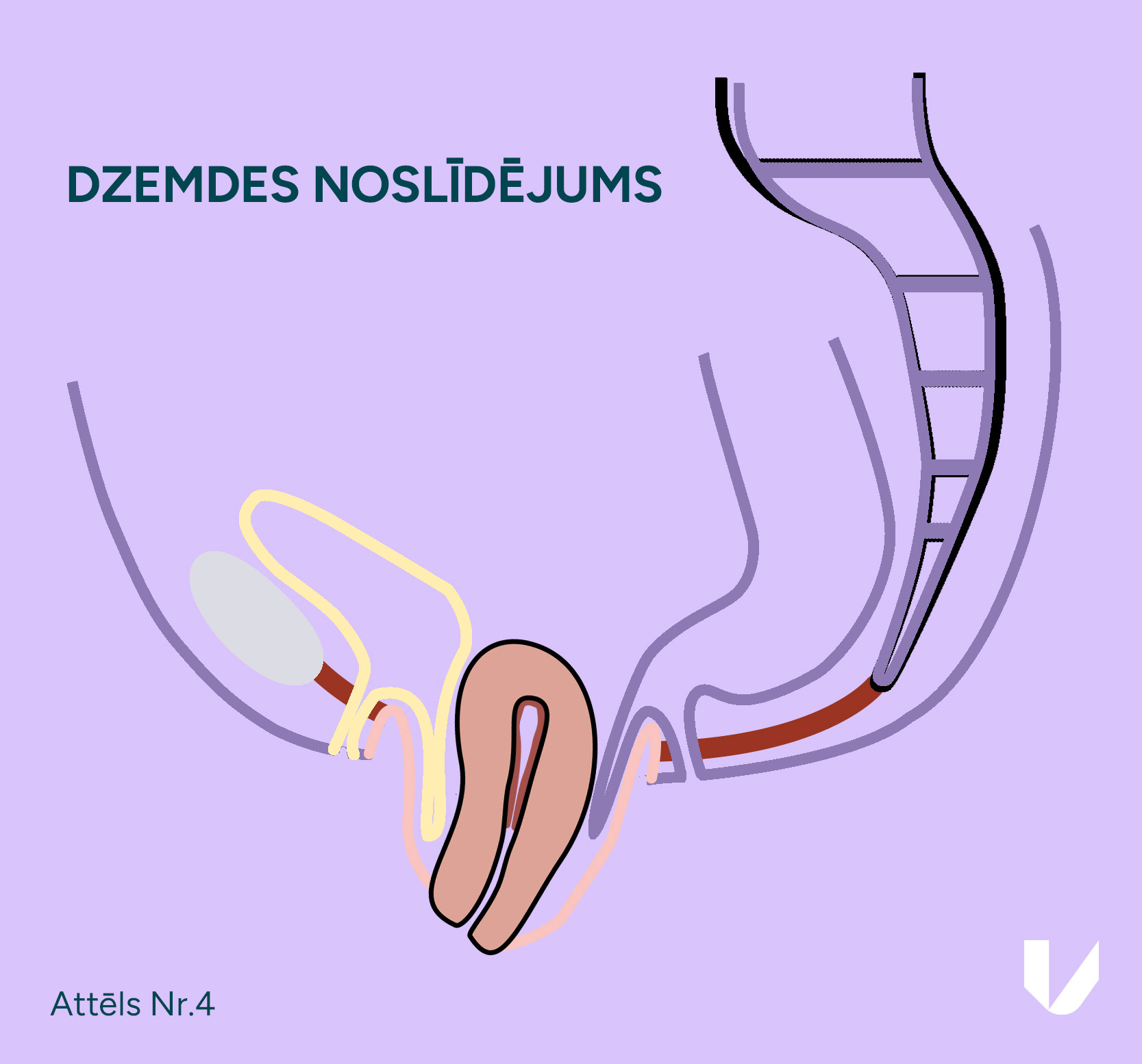 Dzemdes noslīdējums