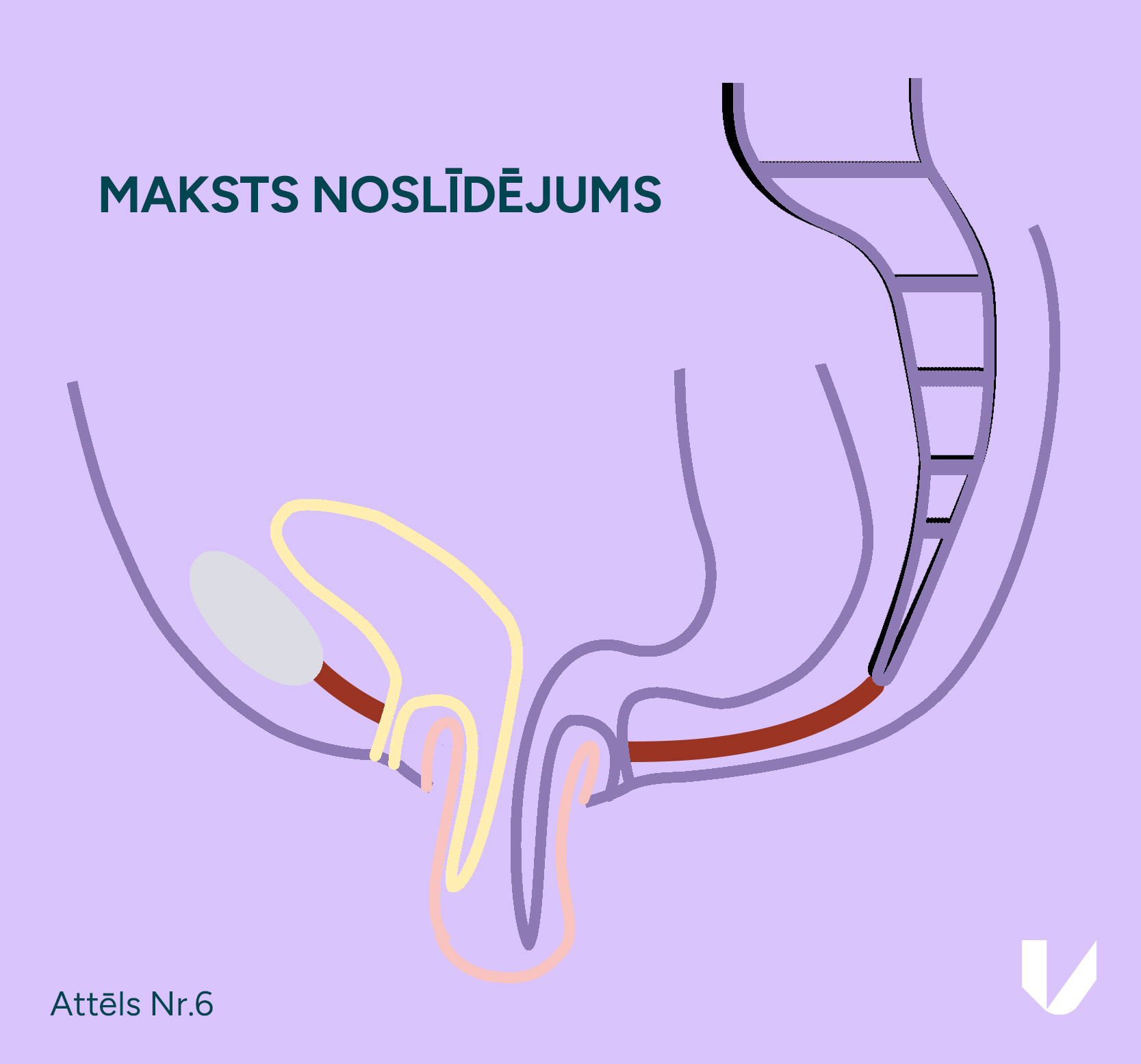 Maksts noslīdējums – iespējams pēc dzemdes izņemšanas