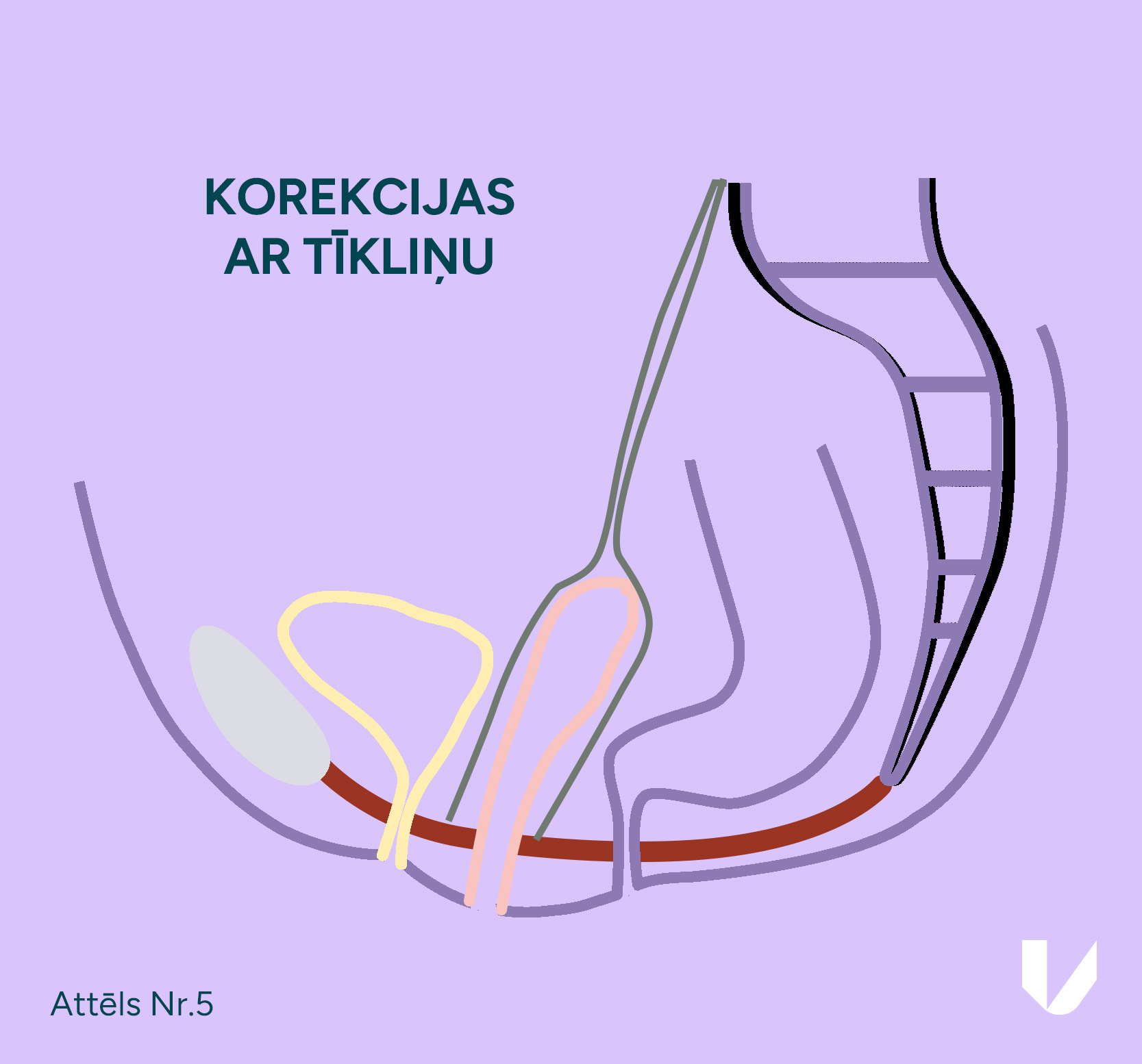 Tīkliņa novietojums pēc iegurņa orgānu prolapsa ārstēšana