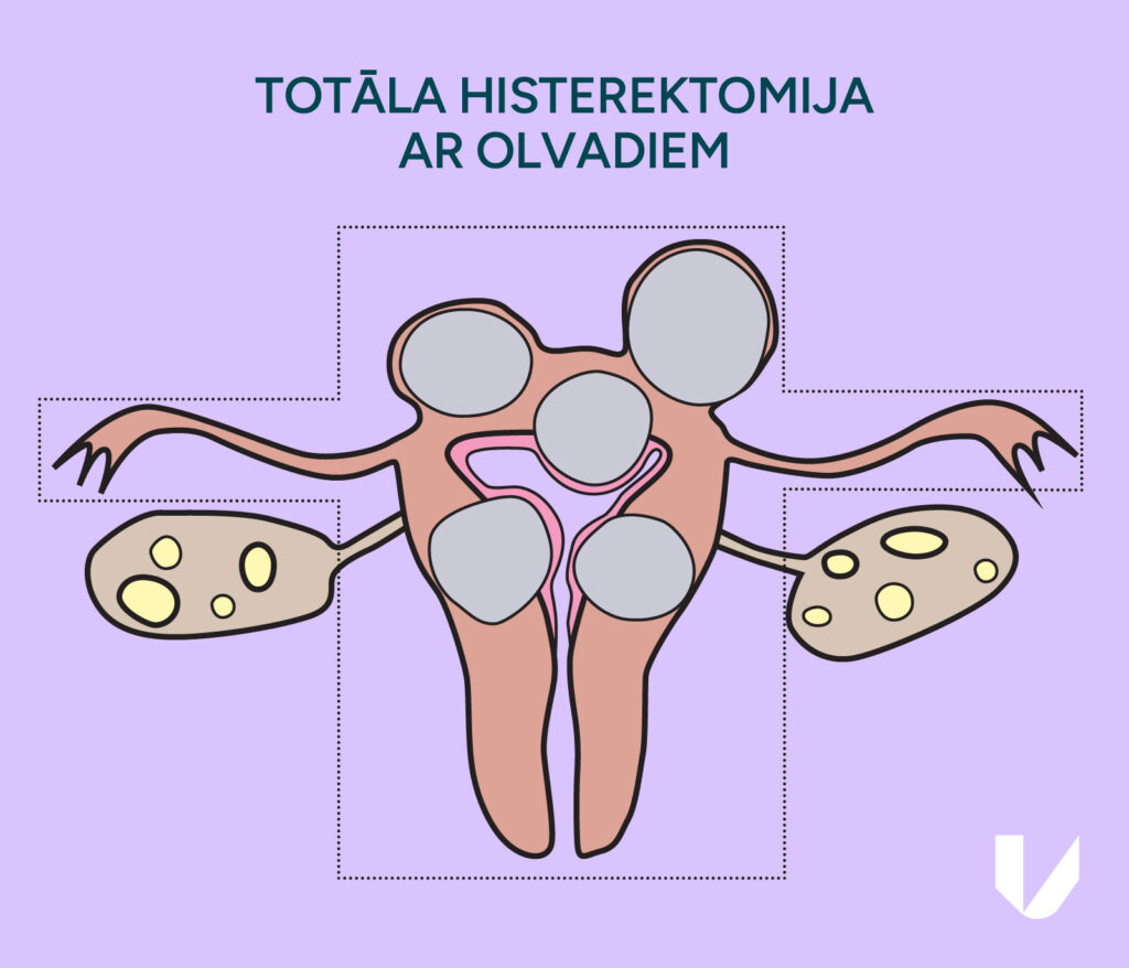 Totāla histerektomija ar olvadiem