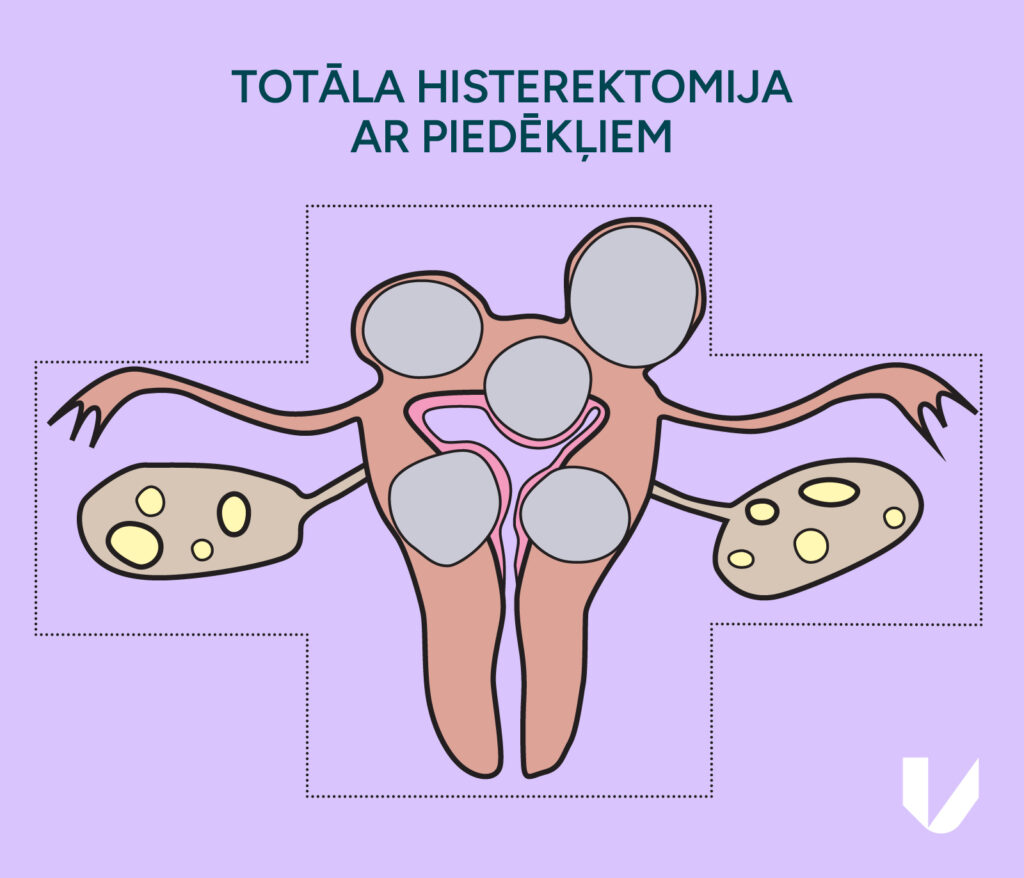 Totāla histerektomija ar priedēkļiem