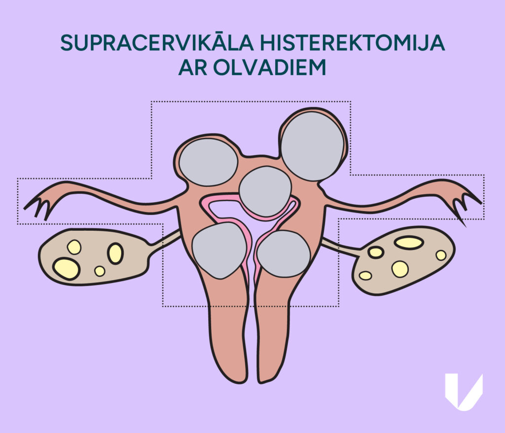 Supracervikāla histerektomija ar olvadiem