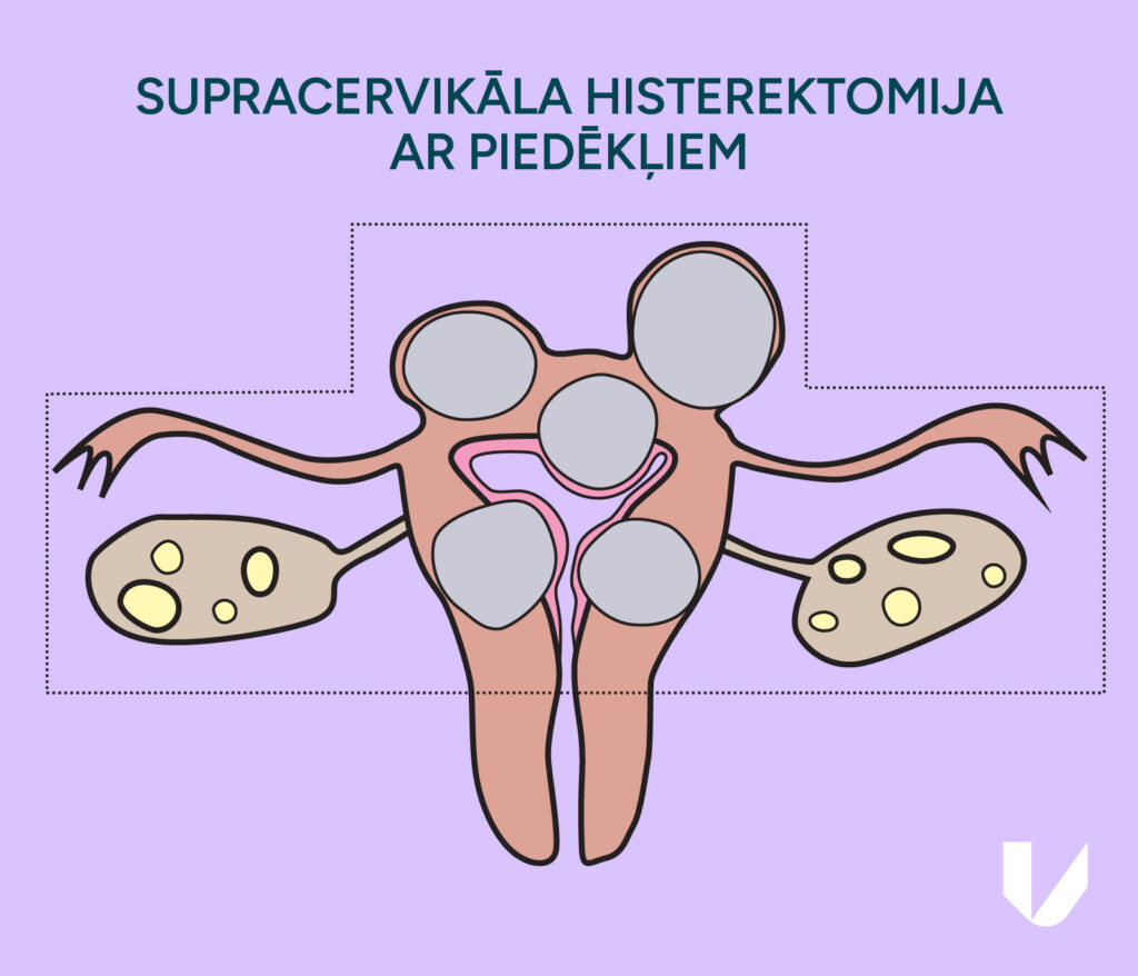 Supracervikāla histerektomija ar priedēkļiem