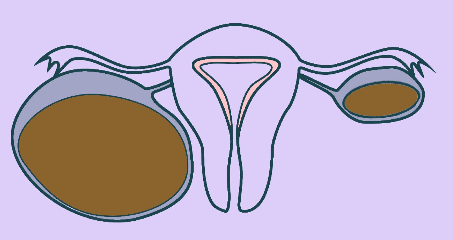 Endometriozes cistas