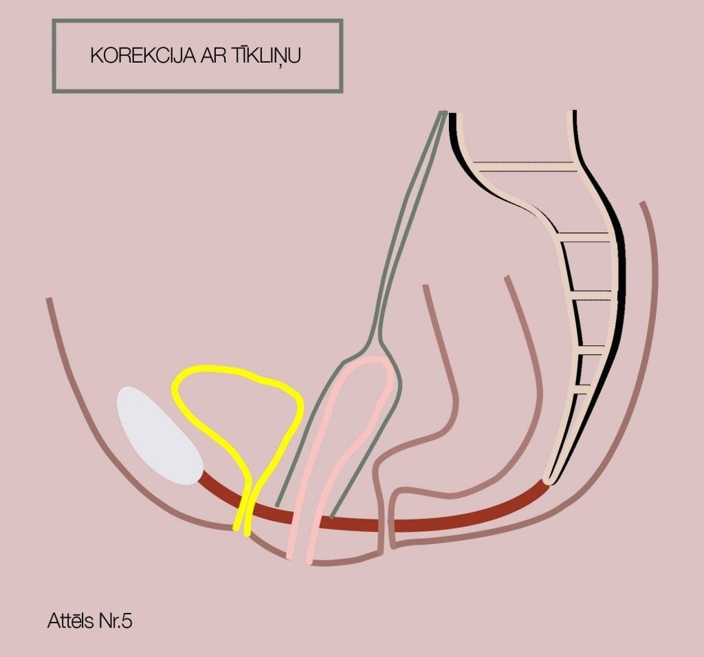 Tīkliņa novietojums pēc iegurņa orgānu prolapsa ārstēšana