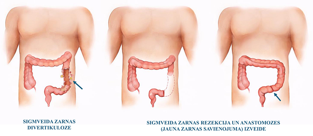 Resnās zarnas divertikulozes ķirurģiska ārstēšana