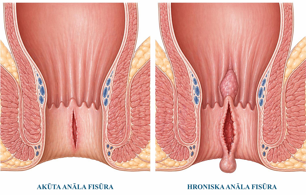 Anāla fisūra