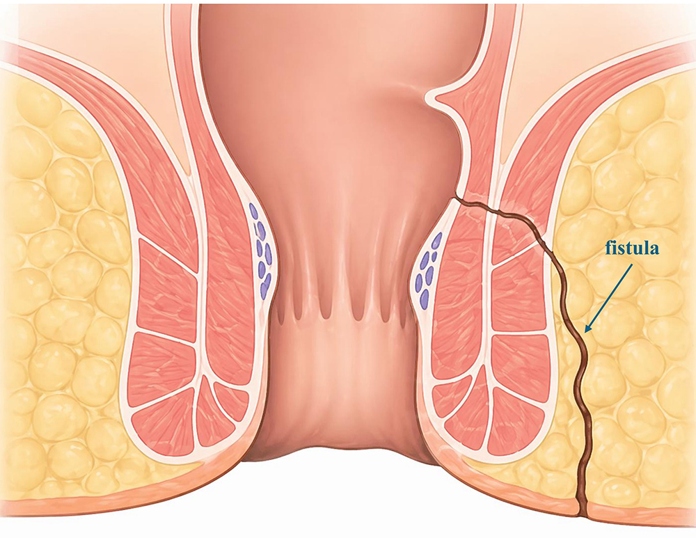 Anāla fistula