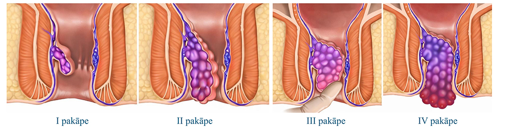 Hemoroidālās slimības pakāpes
