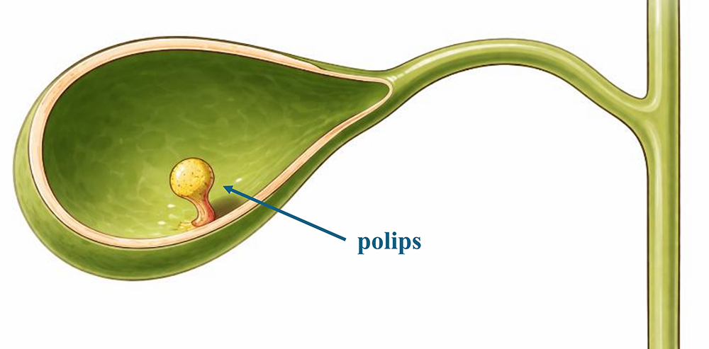 Figure 1. Gallbladder polyp