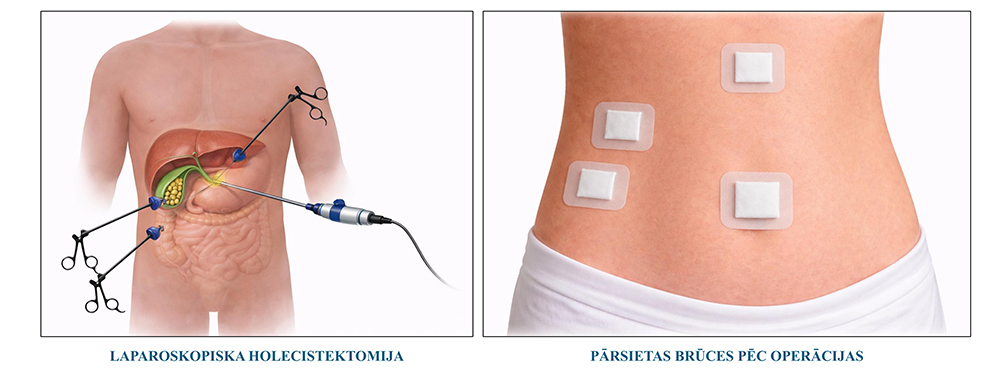Figure 2. Surgical treatment of gallbladder polyps
